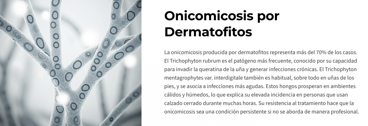 Onicomicosis